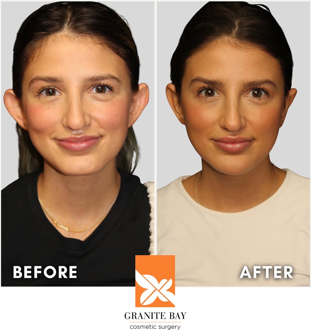 Instagram post by Dr. Christa Clark: Sometimes, a subtle change can make a BIG difference. ✨ This 24-year-old patient came to Dr. Bray for an otoplasty, also known as ear pinnin…