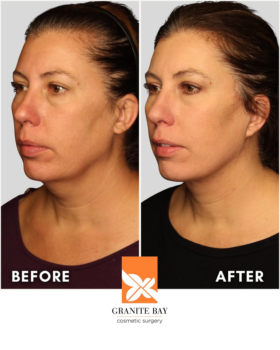 Instagram post by Dr. Christa Clark: THREE MONTHS POST OP 🔥 And this result is only getting better. This patient’s facelift with Dr. Haley Bray has created a sharper jawline, a…
