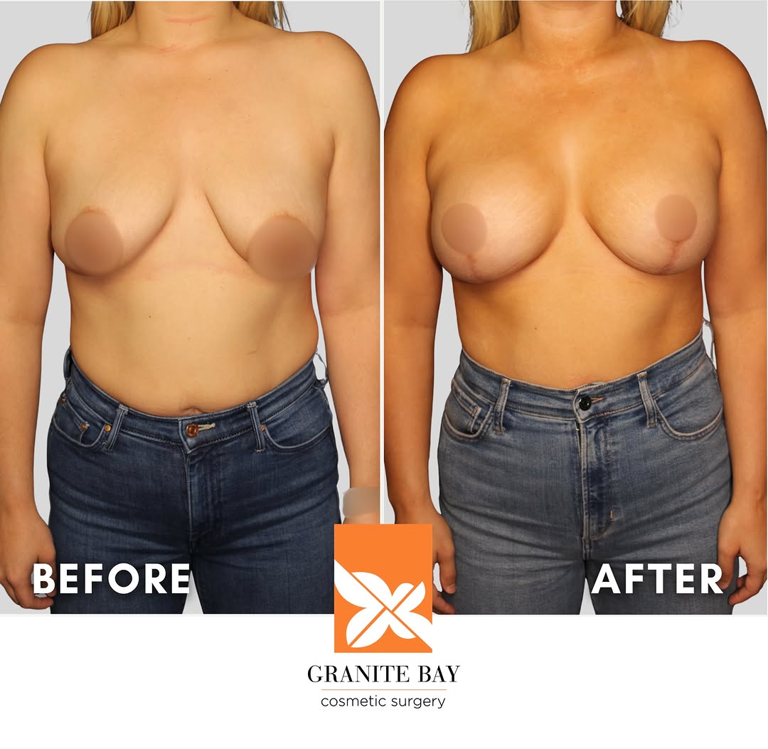 Instagram post by Dr. Christa Clark: Lifted. Fuller. Beautifully balanced. ✨ This 29-year-old patient wanted to restore a more lifted breast shape while adding natural-looking v…