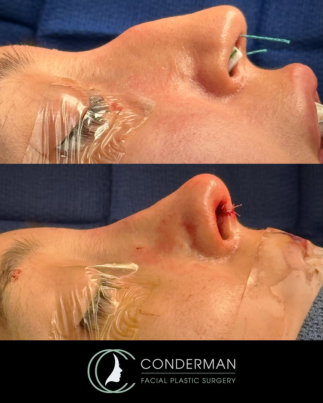 Instagram post by Dr. Christian Conderman: ๐๐ง ๐ญ๐๐๐ฅ๐ ๐ซ๐๐ฌ๐ฎ๐ฅ๐ญ ๐๐จ๐ซ ๐ญ๐ก๐ข๐ฌ ๐๐๐๐ฎ๐ญ๐ข๐๐ฎ๐ฅ ๐ฉ๐๐ญ๐ข๐๐ง๐ญ!โจ She had a prominent nasal bridge that had bothered her for โฆ