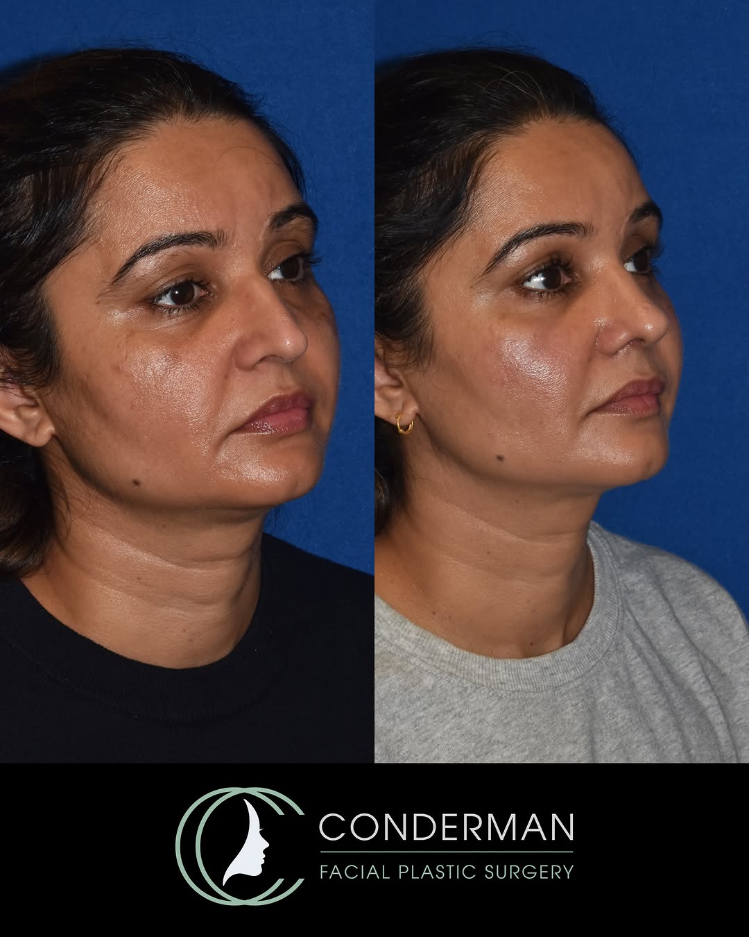 Instagram post by Dr. Christian Conderman: ๐จ๐๐๐๐๐๐ ๐ฎ๐๐๐๐ ๐ช๐๐๐๐ ๐ท๐๐๐๐๐
๐๐๐ โจ This beautiful patient is shown 2.5 months after a combination functional and cosmโฆ