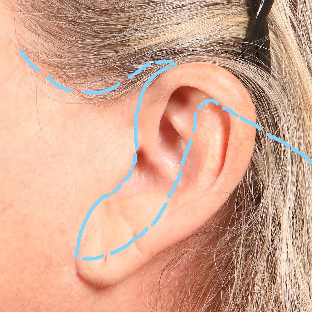 Instagram post by Dr. Christian D. Jacob: Dr. Jacob performed a facelift procedure on this patient. The first picture shows an outline of where the incisions were placed. The second …