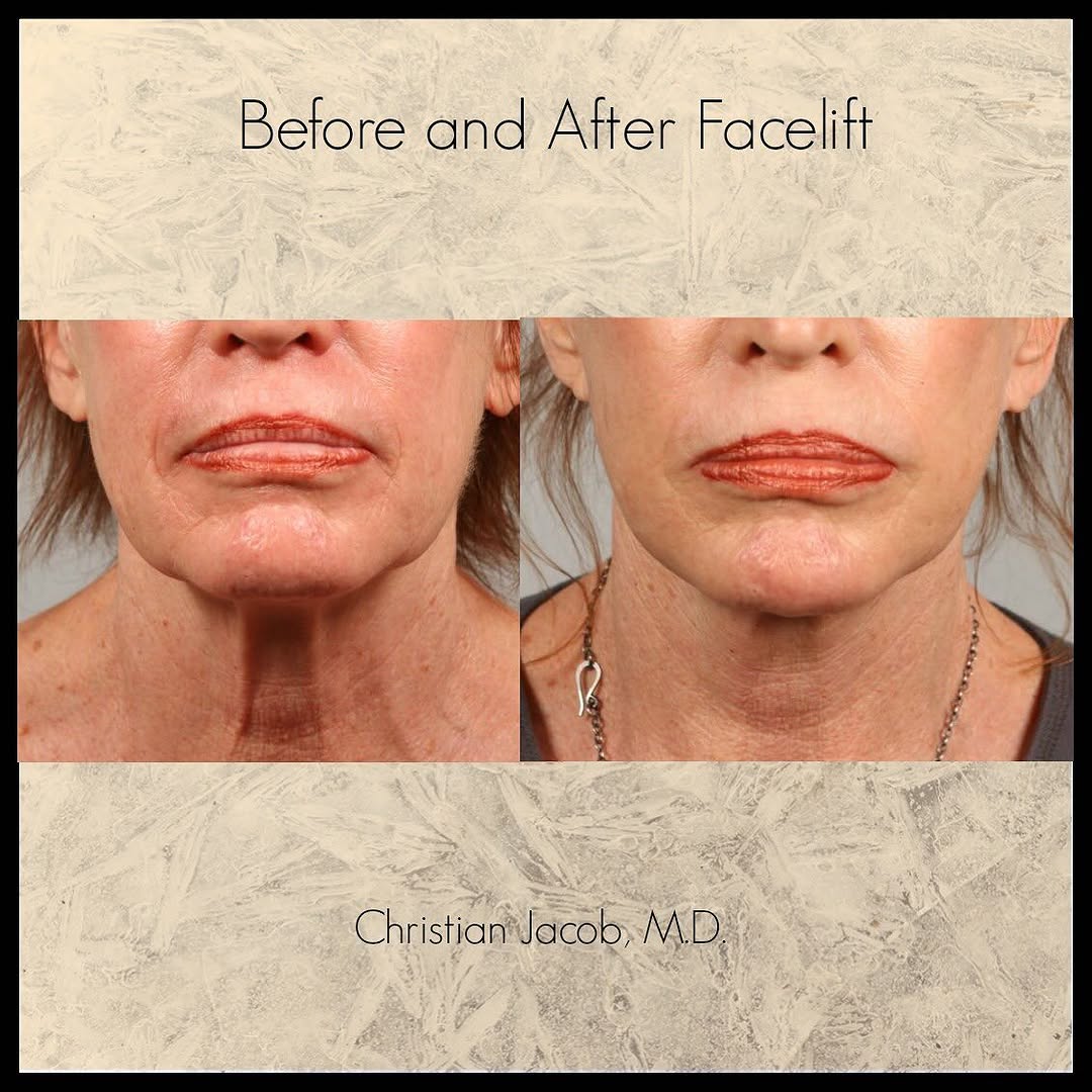 Instagram post by Dr. Christian D. Jacob: This patient underwent a facelift procedure with Dr. Jacob. She loves her more youthful appearance. If you would like to schedule a consulta…