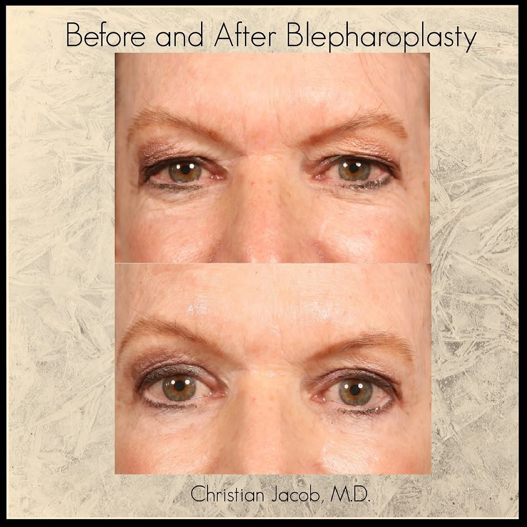 Instagram post by Dr. Christian D. Jacob: After undergoing a blepharplasty procedure, this patient is looking very refreshed! She is very excited about her results. For a consultatio…