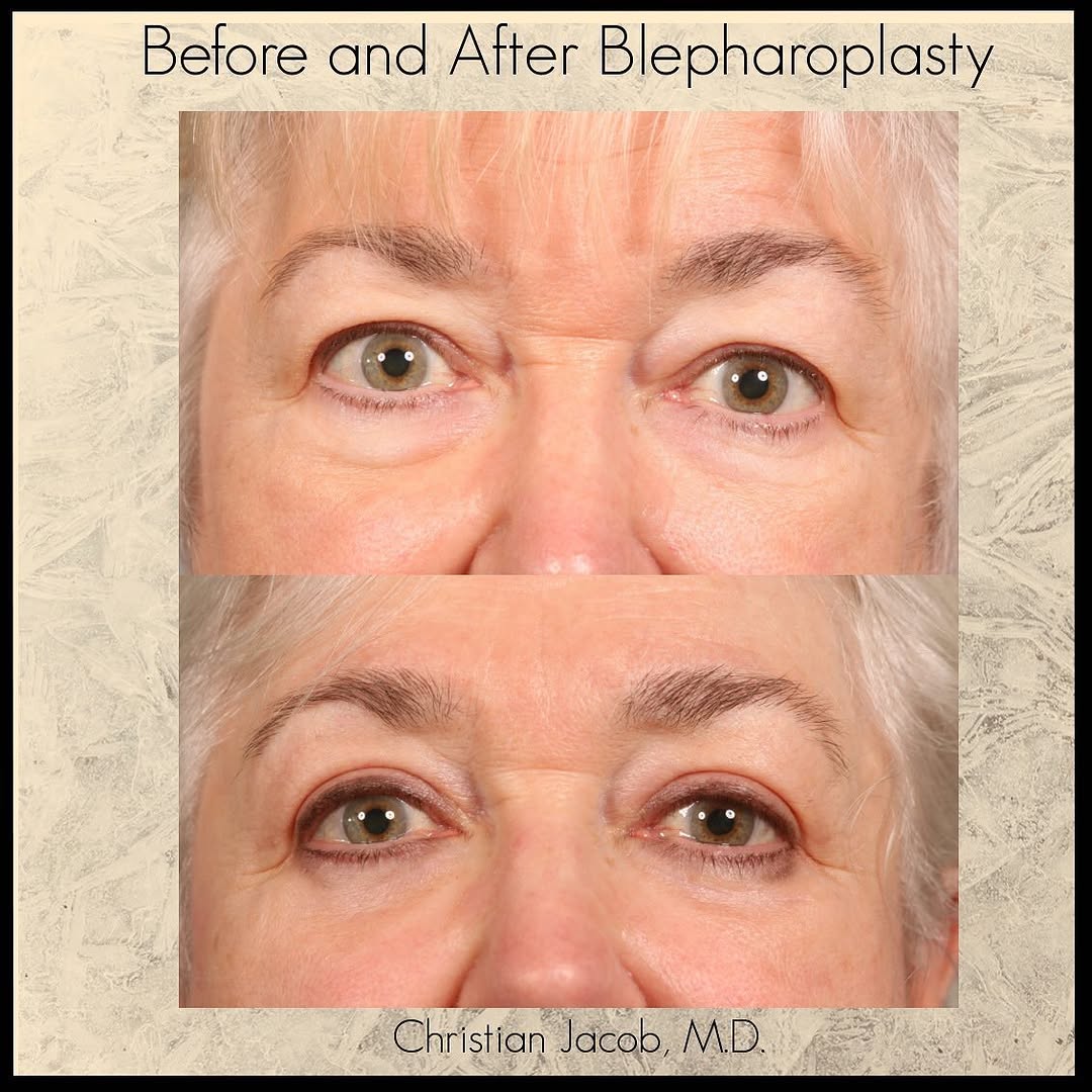 Instagram post by Dr. Christian D. Jacob: Another happy Blepharoplasty patient! Dr. Jacob performed an upper and lower Blepharoplasty with fat transposition and a lower lid skin pinc…
