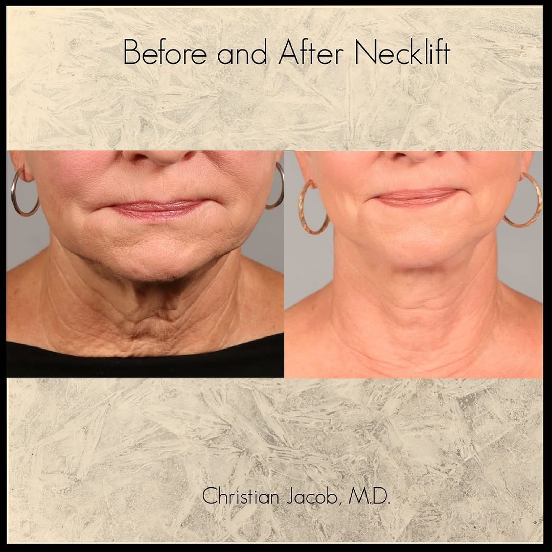 Instagram post by Dr. Christian D. Jacob: This face/neck lift combined with Morpheus microneedling shows the benefits of properly addressing skin laxity. Surgery tightens the deeper …