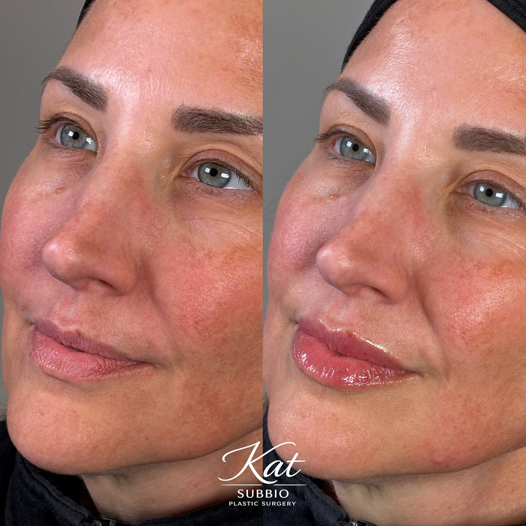 Instagram post by Dr. Christian Subbio: Soft and natural per my usual. 🤷🏻‍♀️ For someone as stunningly gorgeous as this patient, I wanted the first time lip experience to enhance…