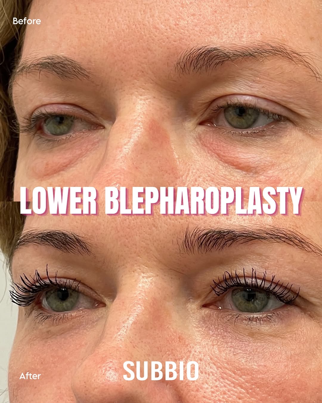 Instagram post by Dr. Christian Subbio: A subtle change can make a remarkable difference ✨ Lower blepharoplasty can smooth under-eye puffiness and reduce the appearance of tired-lo…