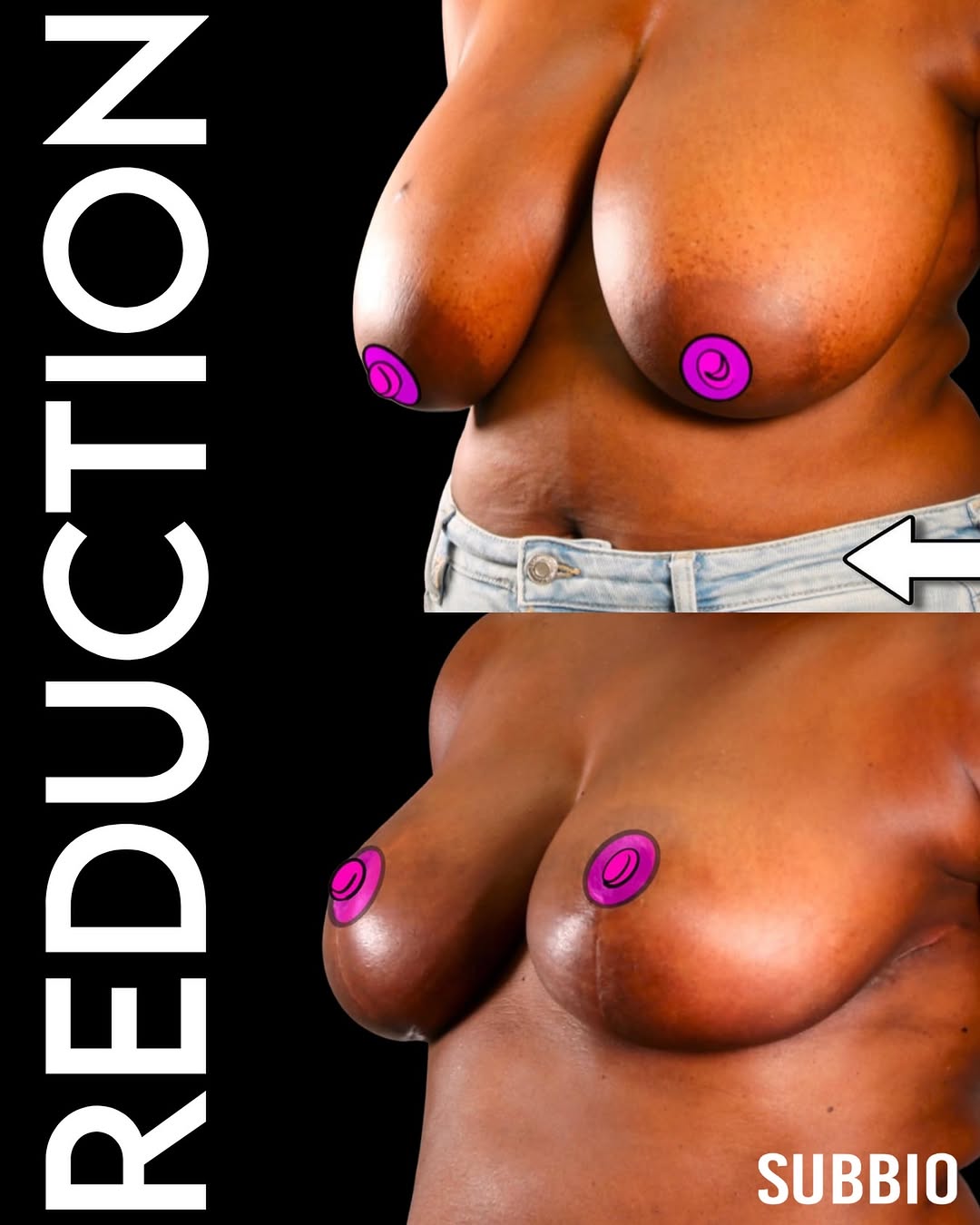 Instagram post by Dr. Christian Subbio: Results by @dr.subbio A breast reduction and lift can do more than change your appearance—it can change the way you move through your day. F…