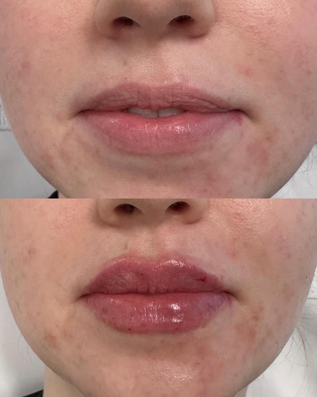 Instagram post by Dr. Christine Rodgers: Virgin lips?! Yes please 😍😍 Loving the results of these lippies with ultra plus 💋💄👄 #juvedermlips #ultraplus #nurseinjector #denvernurs…