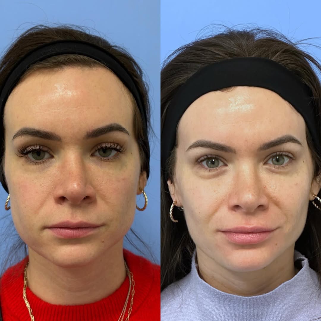 Instagram post by Dr. Christine Rodgers: The glow up! Told you stay tuned for the masseter Botox to kick in 😍 #denvernurseinjector #nurseinjector #medspa #denver #botox