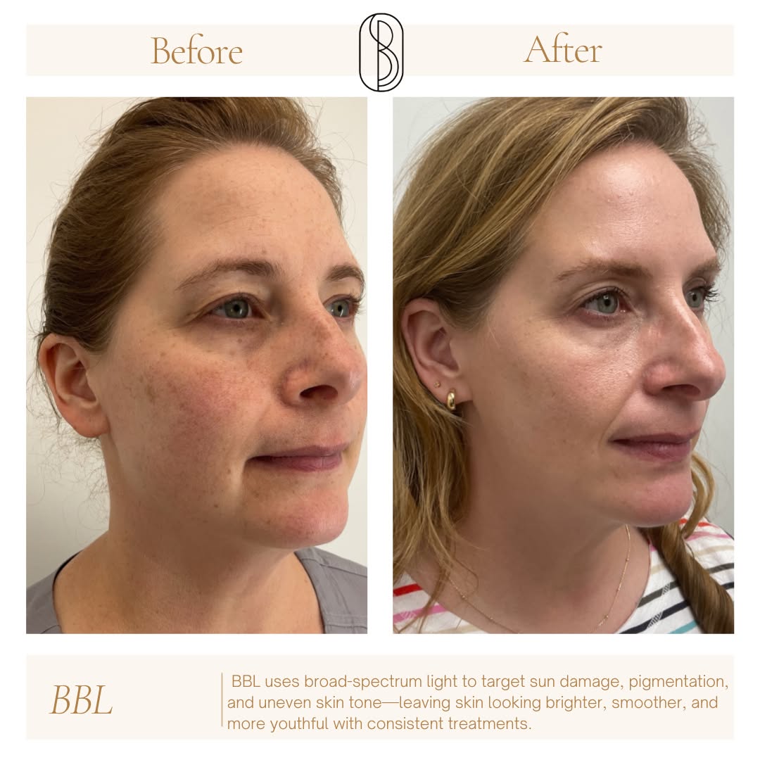 Instagram post by Dr. Christopher A. Marek: Laser season is approaching, and this is your sign to start thinking about your skin! BBL is one of our favorite treatments for addressing s…