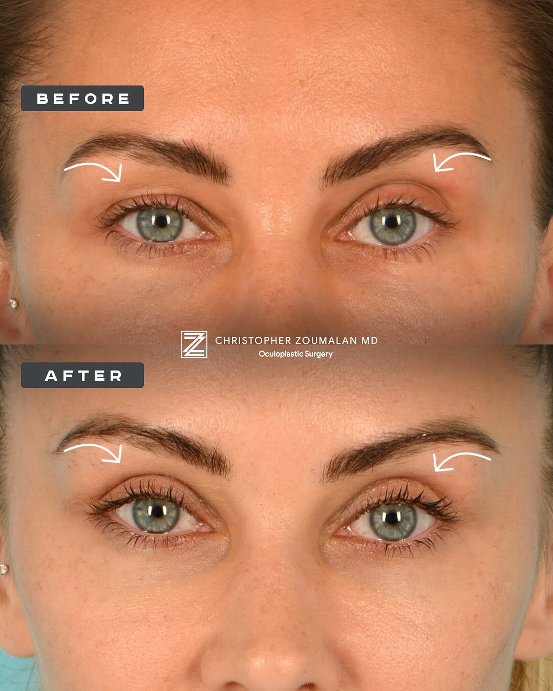 Instagram post by Dr. Christopher I. Zoumalan: Check out this amazing before and after of an in-office upper blepharoplasty on one of our lovely patients. 👁️💖 This quick and effective p…