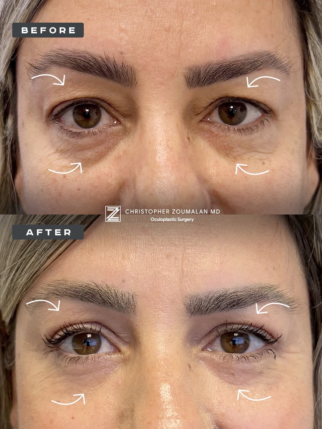 Instagram post by Dr. Christopher I. Zoumalan: This patient came to me after undergoing a prior brow lift and lower blepharoplasty elsewhere. Although she had already had surgery, she rem…