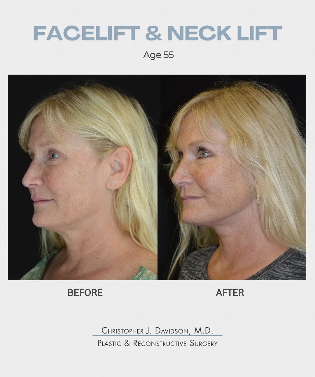 Instagram post by Dr. Christopher J. Davidson: A beautiful transformation with improved definition through the jawline and neck while maintaining a natural, refreshed appearance. • • • #f…