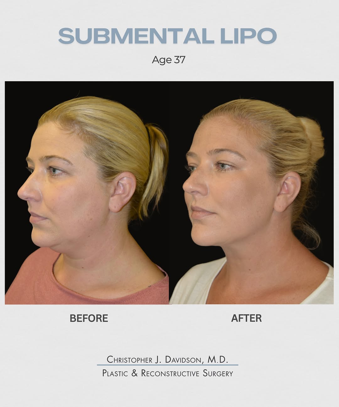 Instagram post by Dr. Christopher J. Davidson: Minor procedure, noticeable change. Submental liposuction can often be performed under local anesthesia in under an hour, with minimal downt…