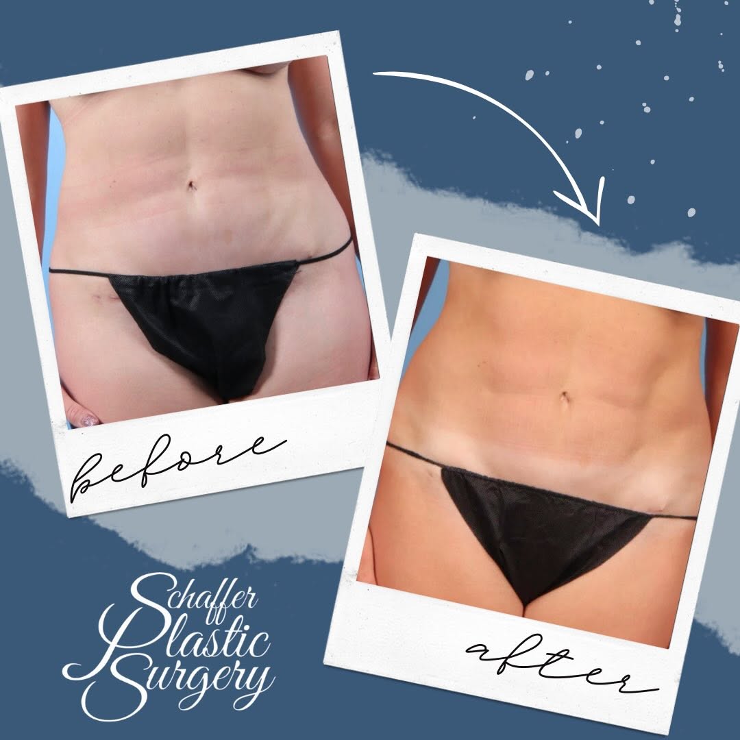 Instagram post by Dr. Christopher J. Schaffer: BODYTONE(d) ✨✨Before and After Results with our BODYTONE machine for body contouring and improving muscle presence✨Summer body goals start i…