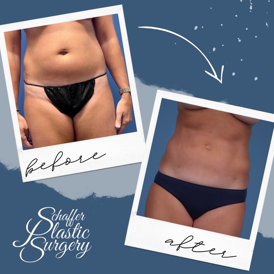 Instagram post by Dr. Christopher J. Schaffer: #WhyDrSchafferWednesday Need we say more… Beautiful Before and After Liposuction of Lower Abdomen and Flanks 👨🏼🍳<— Dr. Schaffer