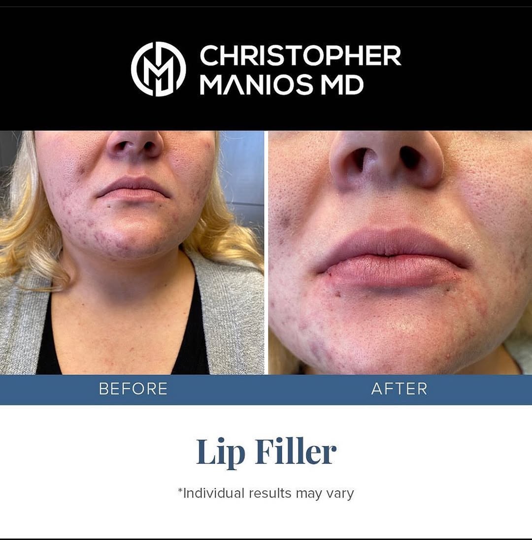 Instagram post by Dr. Christopher Manios: An amazing lip filler result by Dr. Manios! She came in wanting fuller, natural-looking lips, and she achieved it! ☺️ what do you think? . F…