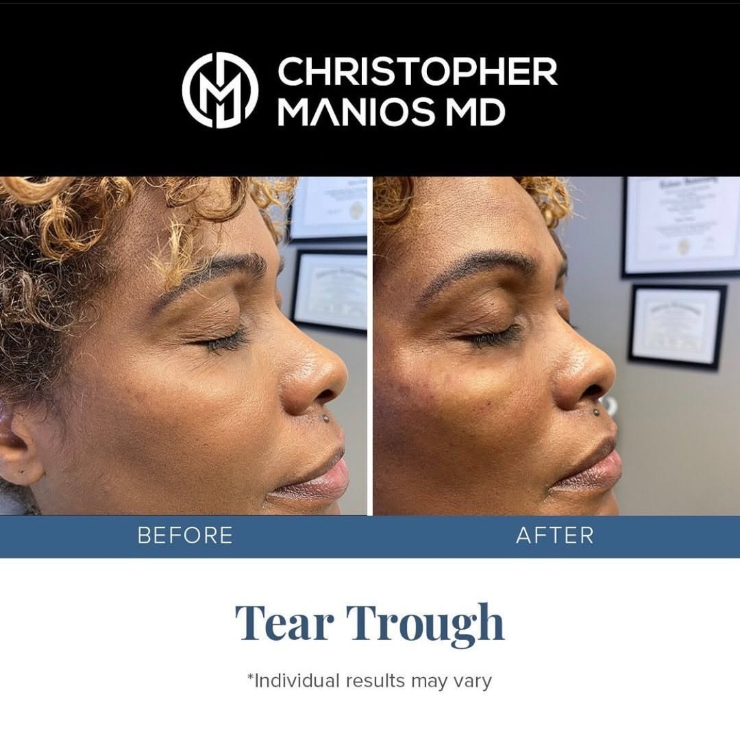 Instagram post by Dr. Christopher Manios: Spring into the new season looking and feeling refreshed! My patient received a tear trough treatment to smooth the skin beneath her eyes. T…