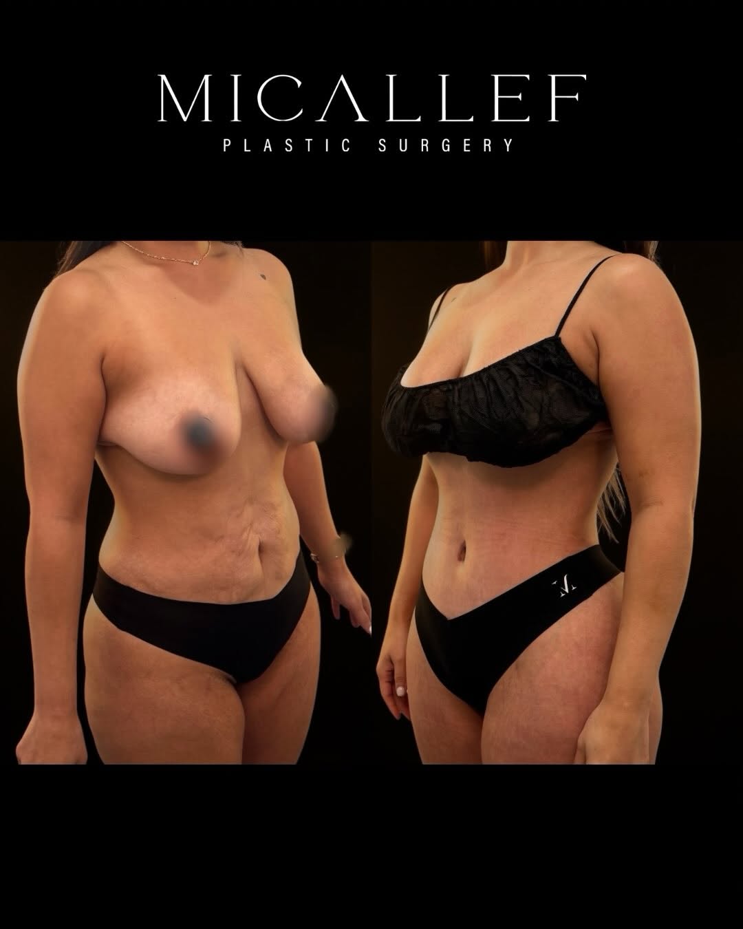 Instagram post by Dr. Christopher Micallef, DO: 360° LIPO + TUMMY TUCK Curves where you want them. Definition where you need it. And results that still look natural. This beautiful transfo…