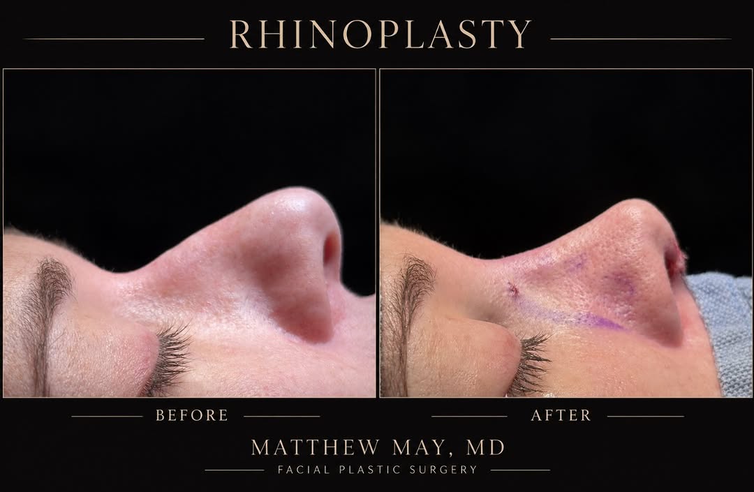 Instagram post by Dr. Christopher Park: On the table result from a rhinoplasty this past week. You can see the dorsal hump is gone and the tip of the nose is more elegant. We can p…