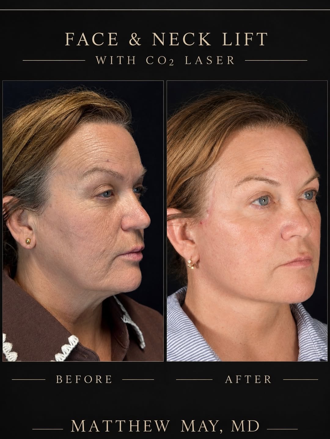 Instagram post by Dr. Christopher Park: Early results 4 months out from another face and neck lift. So excited for this patient. In the early stages, patients can continue to have …