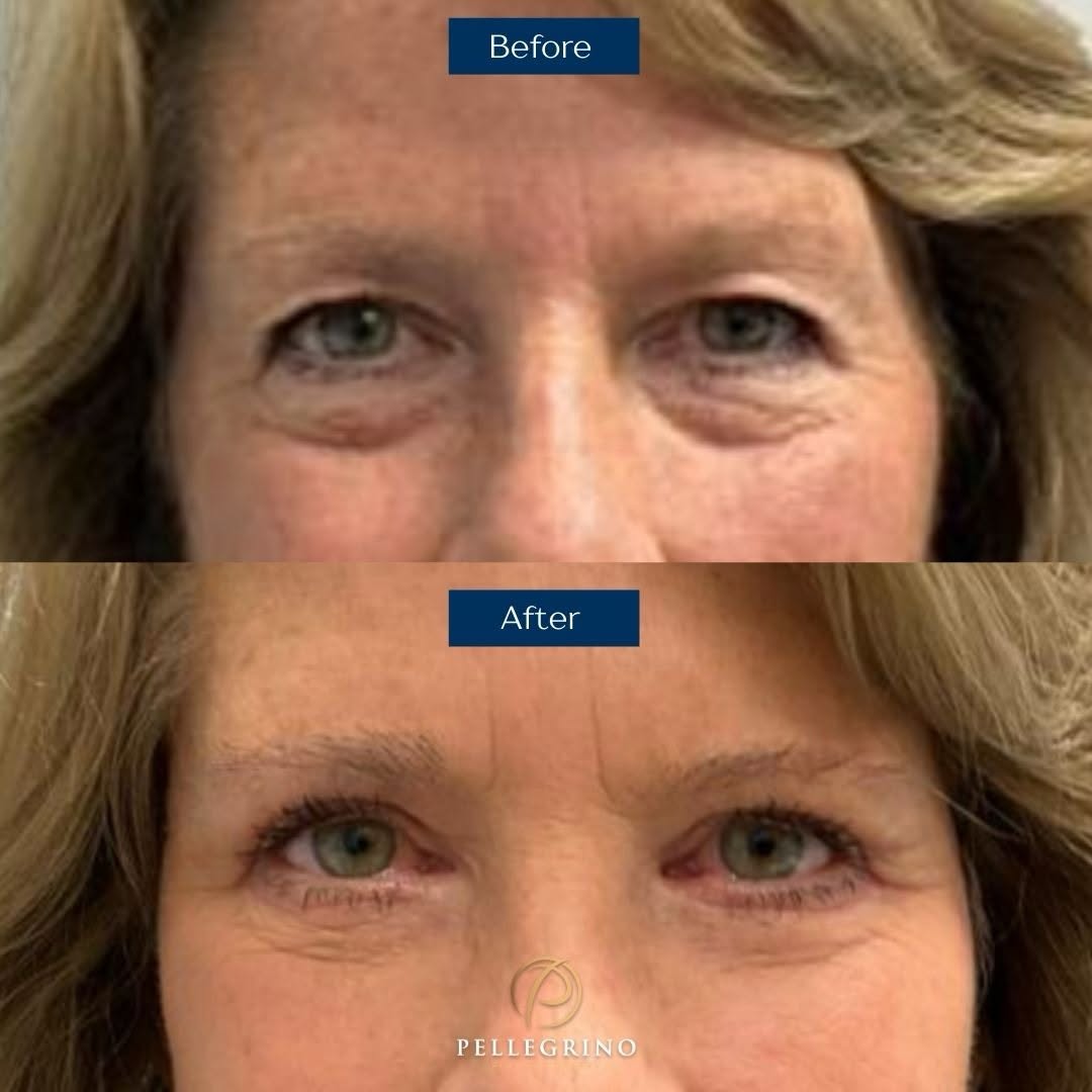 Instagram post by Dr. Christopher Pellegrino: Before and after transformation ✨ This is the result of an upper and lower blepharoplasty!