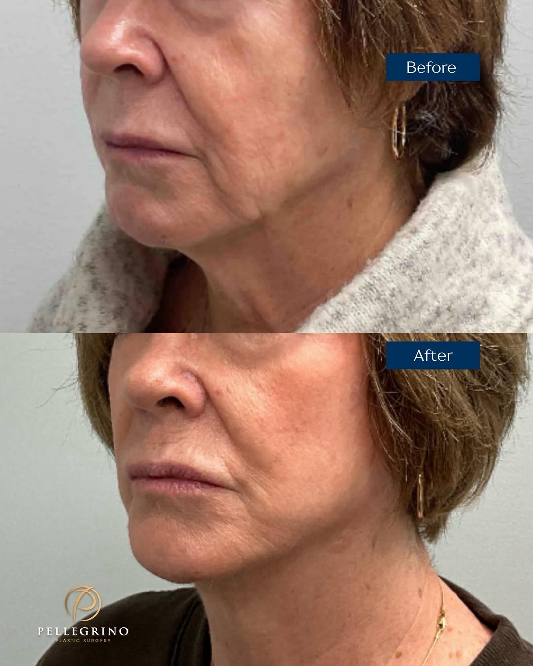 Instagram post by Dr. Christopher Pellegrino: Before and after transformation ✨ This is a result of a mini facelift!