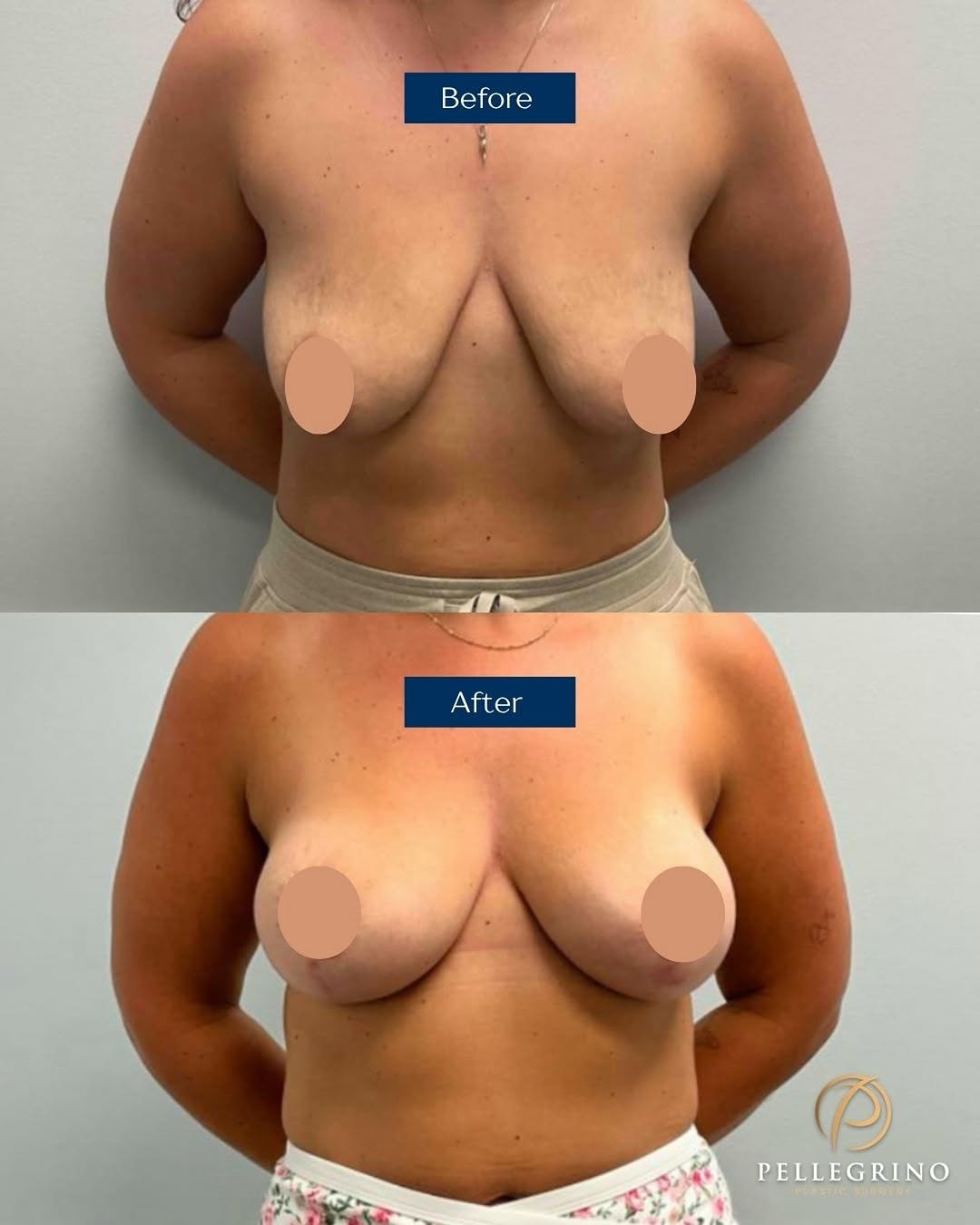 Instagram post by Dr. Christopher Pellegrino: Before and after ✨ This is a result of a breast augmentation with Natrelle silicone implants SRM-310 and a breast lift