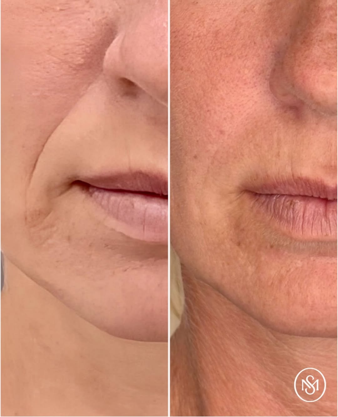 Instagram post by Dr. Christopher Sesslar: 💉A little smile line enhancement makes rolling into the weekend much more fun! We injected Restylane Refyne using the fern technique (super…