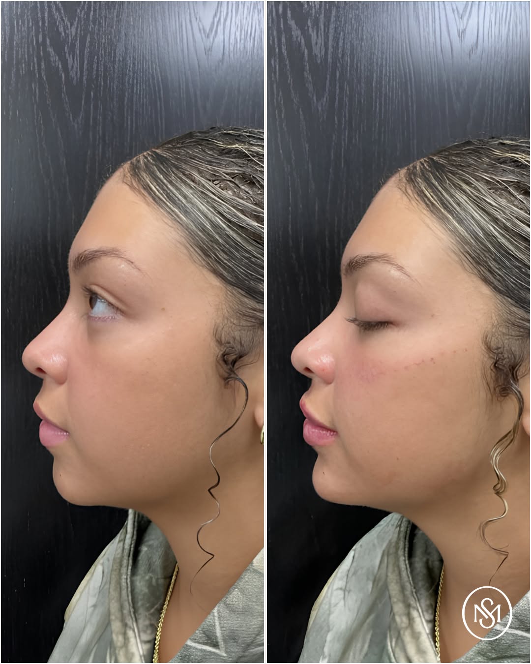 Instagram post by Dr. Christopher Sesslar: New side profile loading... Lips, chin, and cheeks filler is honestly one of our favorite combinations because the results speak for themsel…