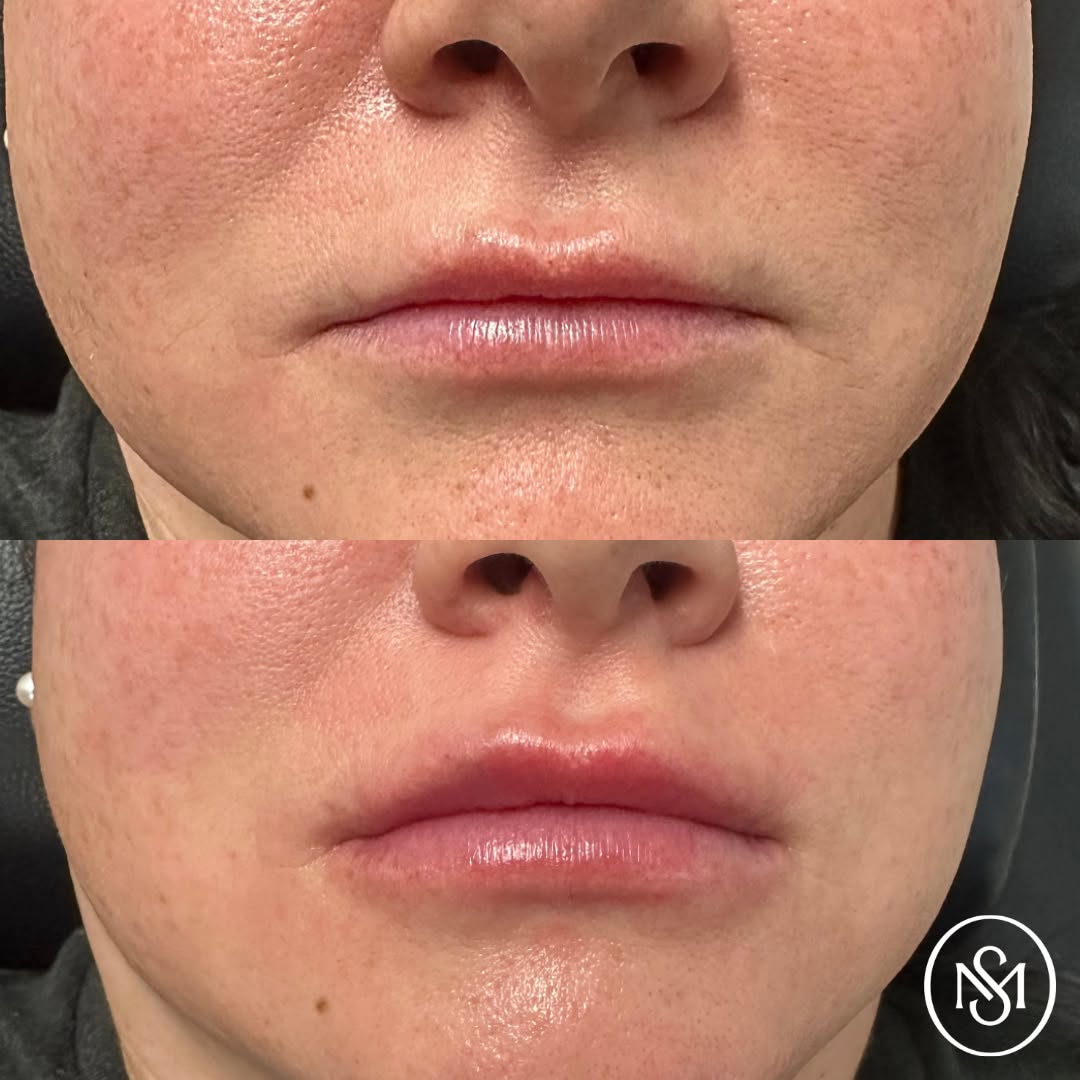 Instagram post by Dr. Christopher Sesslar: Rachel’s work speaks for itself. 💋 This before + after from our Kentucky location is all about creating a beautiful result that complements…