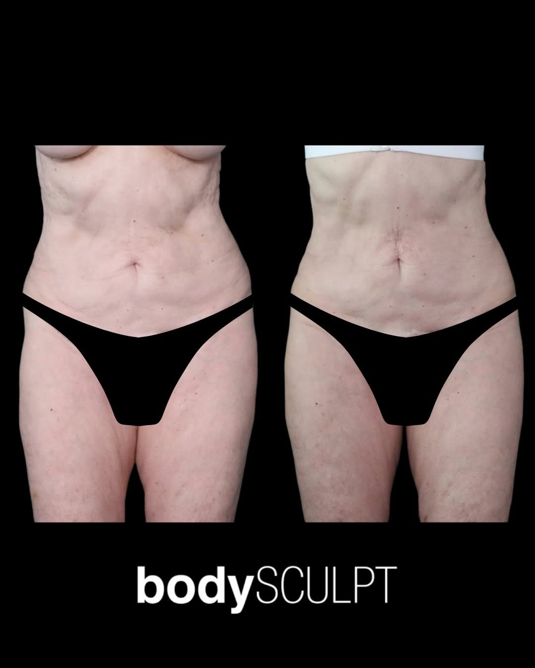 Instagram post by Dr. Christopher T. Chia: ✨ Confidence, contoured. ✨ This patients transformation features VASER liposuction to the abdomen and flanks with fat transfer to correct hi…