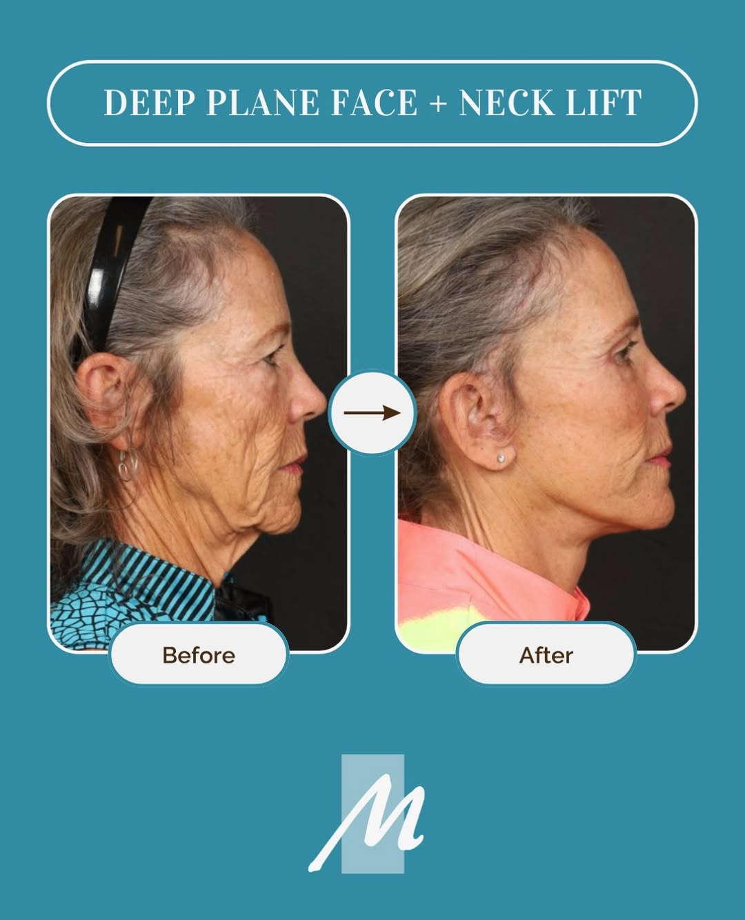 Instagram post by Dr. Christopher T. Maloney Jr.: 2 months post-op, and this is what a deep plane facelift with neck sculpting can do. Dr. Maloney’s full approach for this 73-year-old patien…