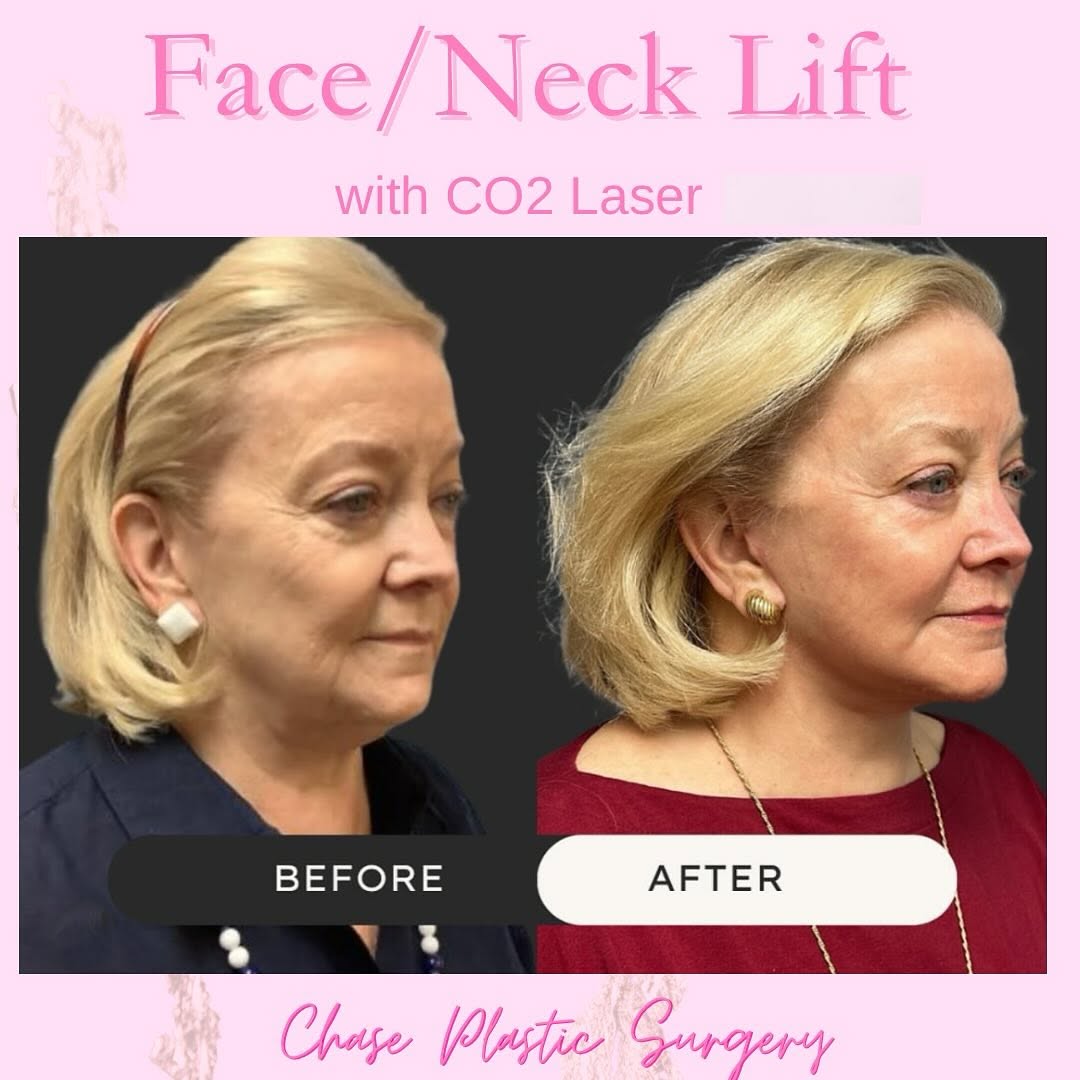 Instagram post by Dr. Christopher W. Chase: ELEGANT.. This one word describes the feel of this beautiful client🫶🏻 Face / Neck Lift with CO2 Laser By Dr. Chase WHAT DO YOU THINK??? #n…