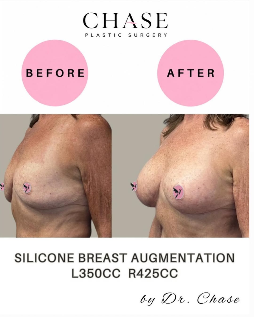 Instagram post by Dr. Christopher W. Chase: Confidence, beautifully customized. 🤍 Silicone breast augmentation can enhance shape, restore volume and create a fuller, more balanced sil…