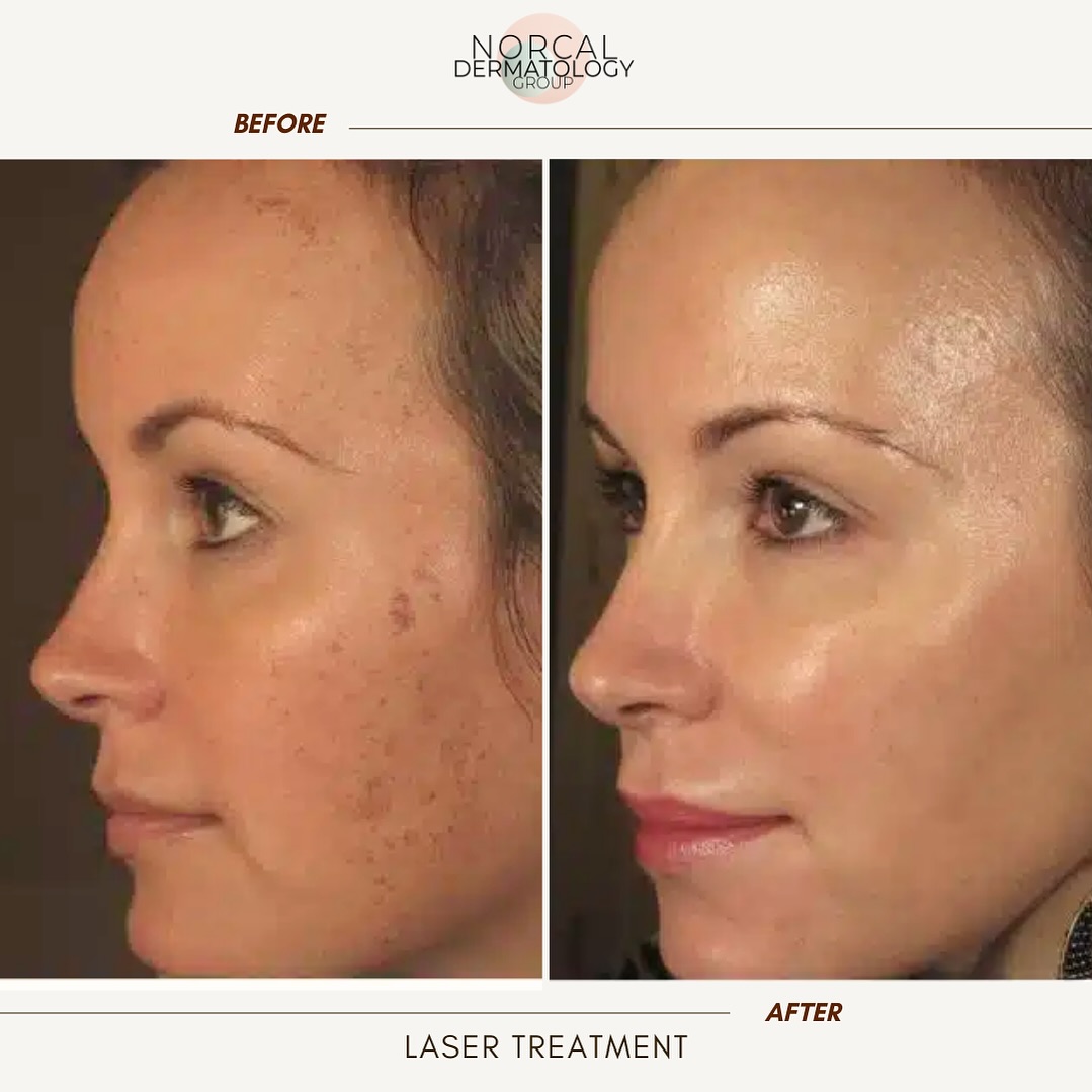 Instagram post by Dr. Clemens Esche: At NorCal Dermatology Group, we know acne affects people of all ages, not just teenagers. That’s why our board-certified providers create pe…