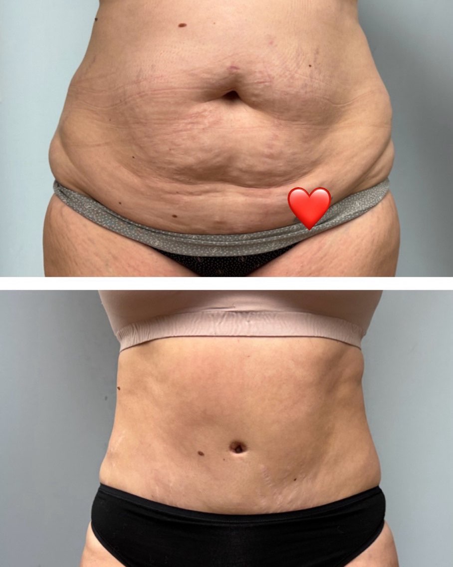 Instagram post by Dr. Colette Stern: Love giving these mamas their bellies back! It’s been a busy winter of mommy makeovers 😍