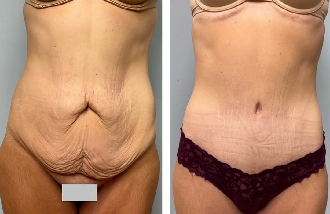 Instagram post by Dr. Colette Stern: This sweet patient lost over 115 lbs! So gratifying…yet also frustrating to be left with so much loose skin. Loved helping her to finally se…