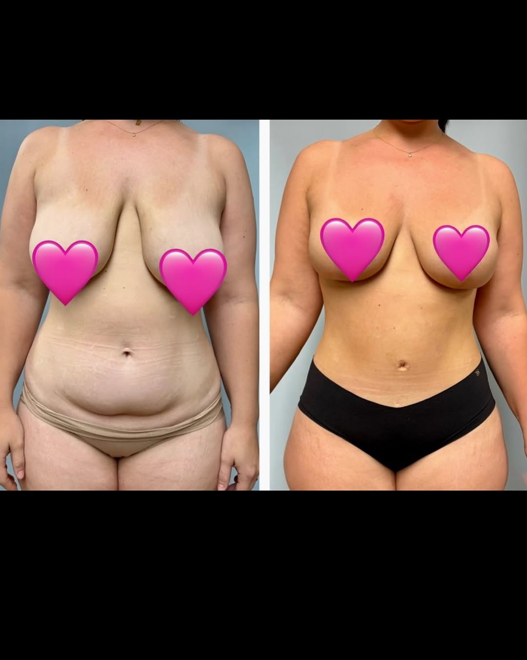 Instagram post by Dr. Colette Stern: Our specialty- Mommy Makeovers! Love the immediate gratification of these combination surgeries. So thankful for the trust moms place in us …