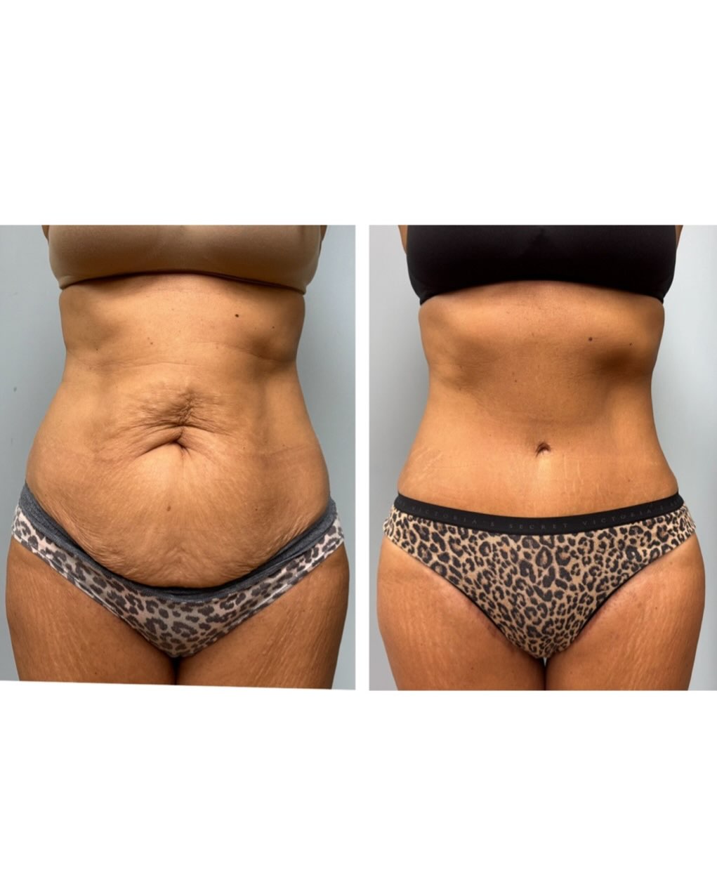 Instagram post by Dr. Colette Stern: Will never stop loving the immediate gratification of a tummy tuck 😁 #ashevilleplasticsurgery #828isgreat #tummytuck