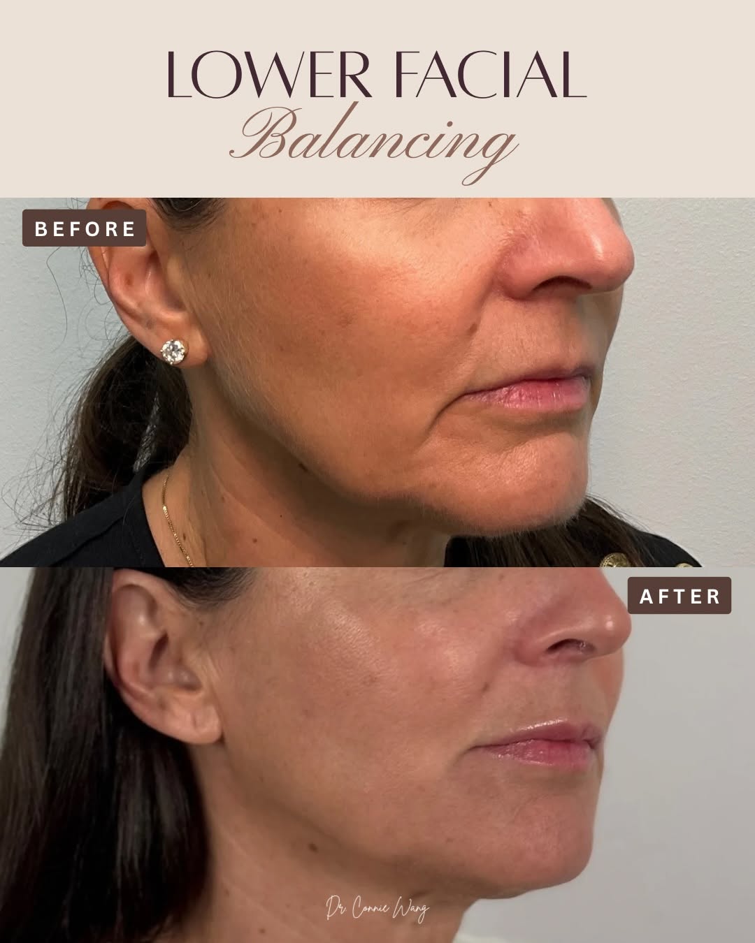 Instagram post by Dr. Connie Wang: Lower face refresh 👄✨ Instead of chasing one line or one area, I look at how the entire lower face works together because it does. For this…