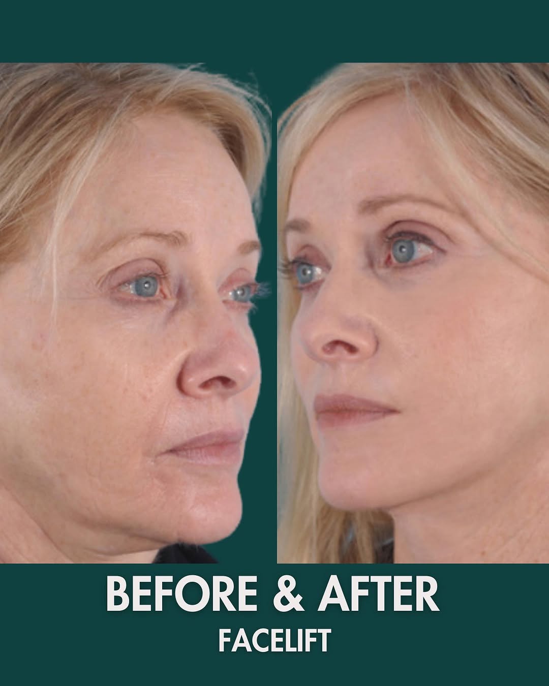 Instagram post by Dr. Corey S. Maas: Did someone call for a time machine? Our patient turned back the clock with a #Facelift transformation. ✨ SWIPE ⬅️ to view her transforma…