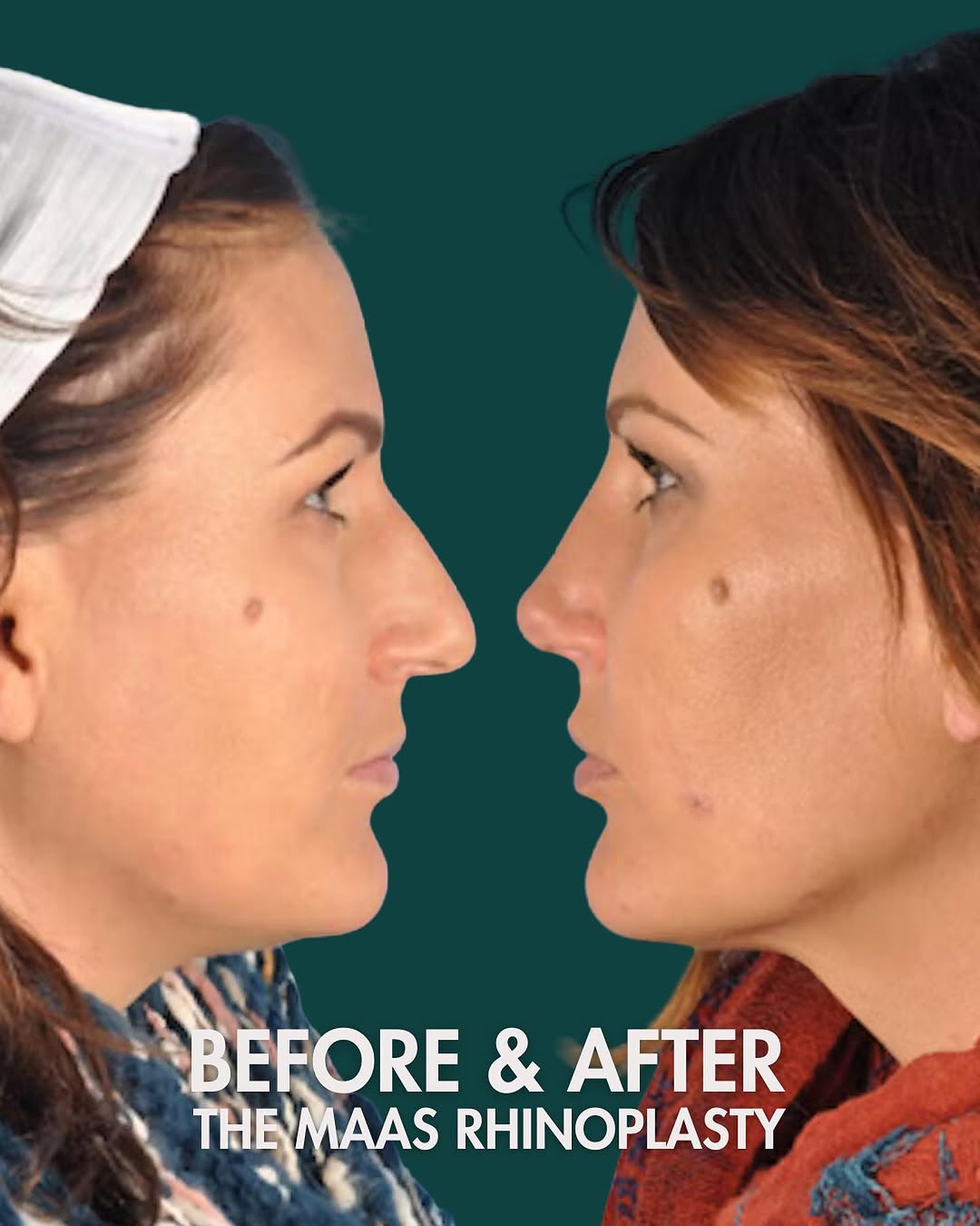 Instagram post by Dr. Corey S. Maas: Rhinoplasty - where form meets function to create perfect harmony! 👃 Our patient looks beautiful after her procedure. SWIPE 👉 for more ang…
