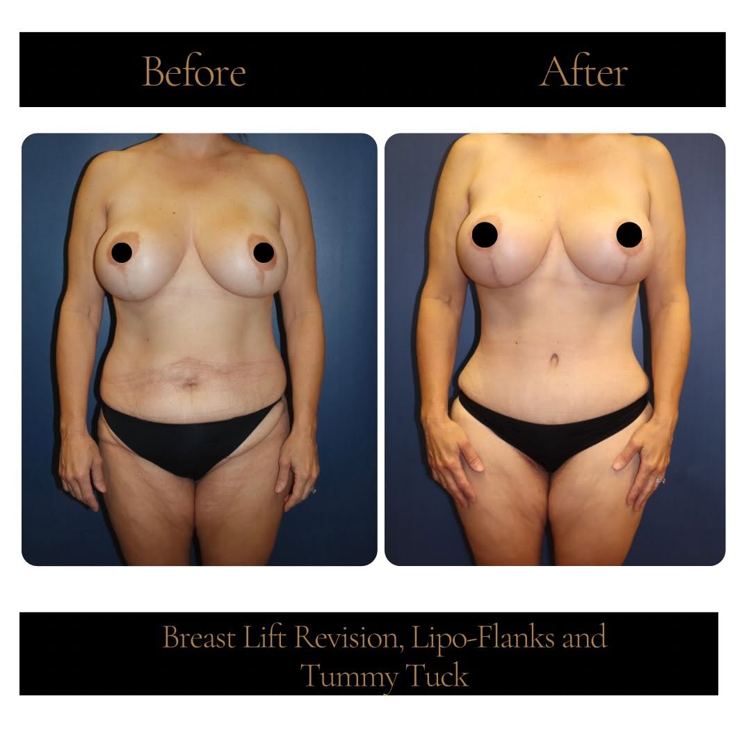Instagram post by Dr. Corwin Martin: This patient underwent a tummy tuck, breast lift revision, and liposuction to create a more balanced, refined silhouette. We love seeing the…