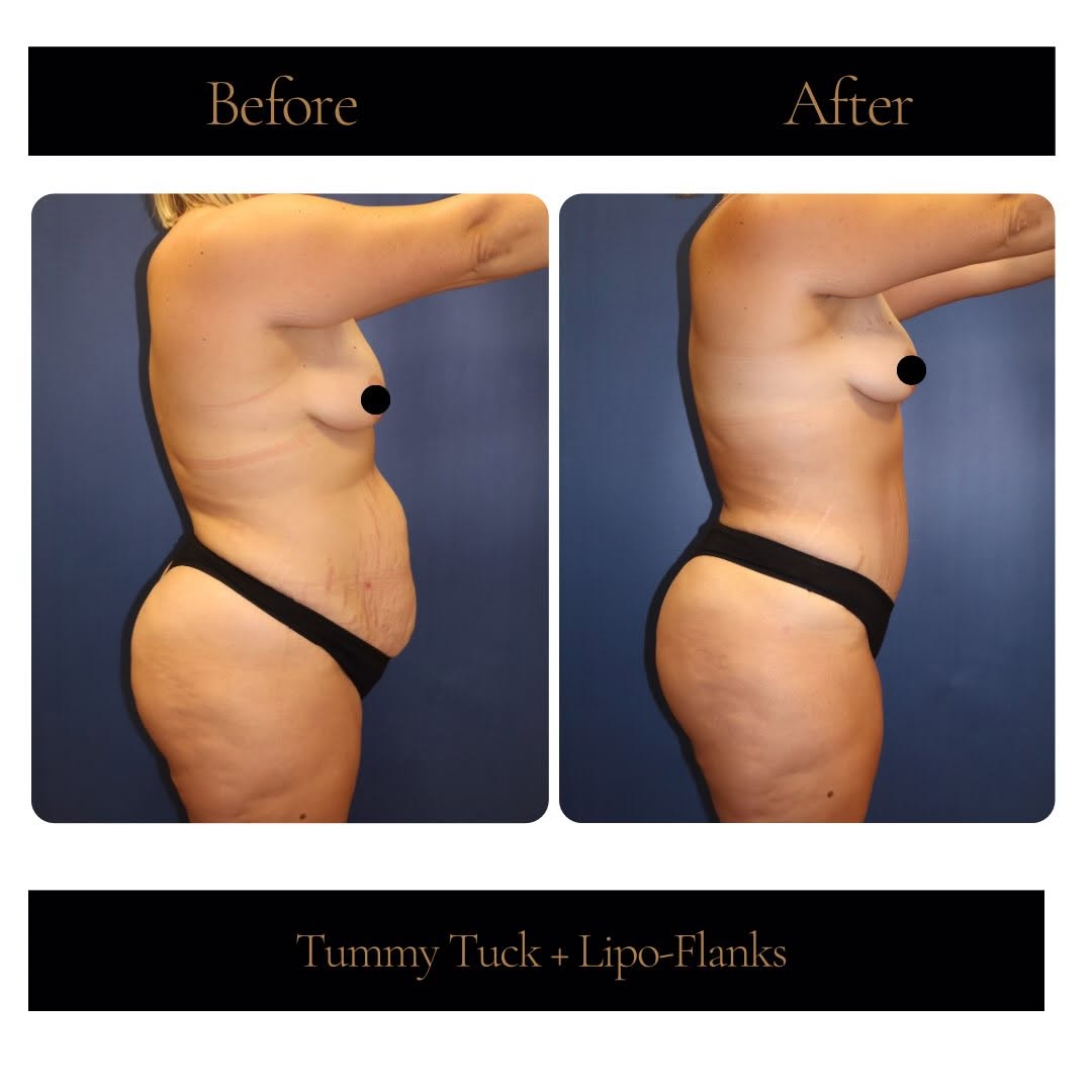 Instagram post by Dr. Corwin Martin: This patient underwent a tummy tuck with liposuction of the flanks, creating a flatter, smoother abdomen and a more defined waistline. Her b…