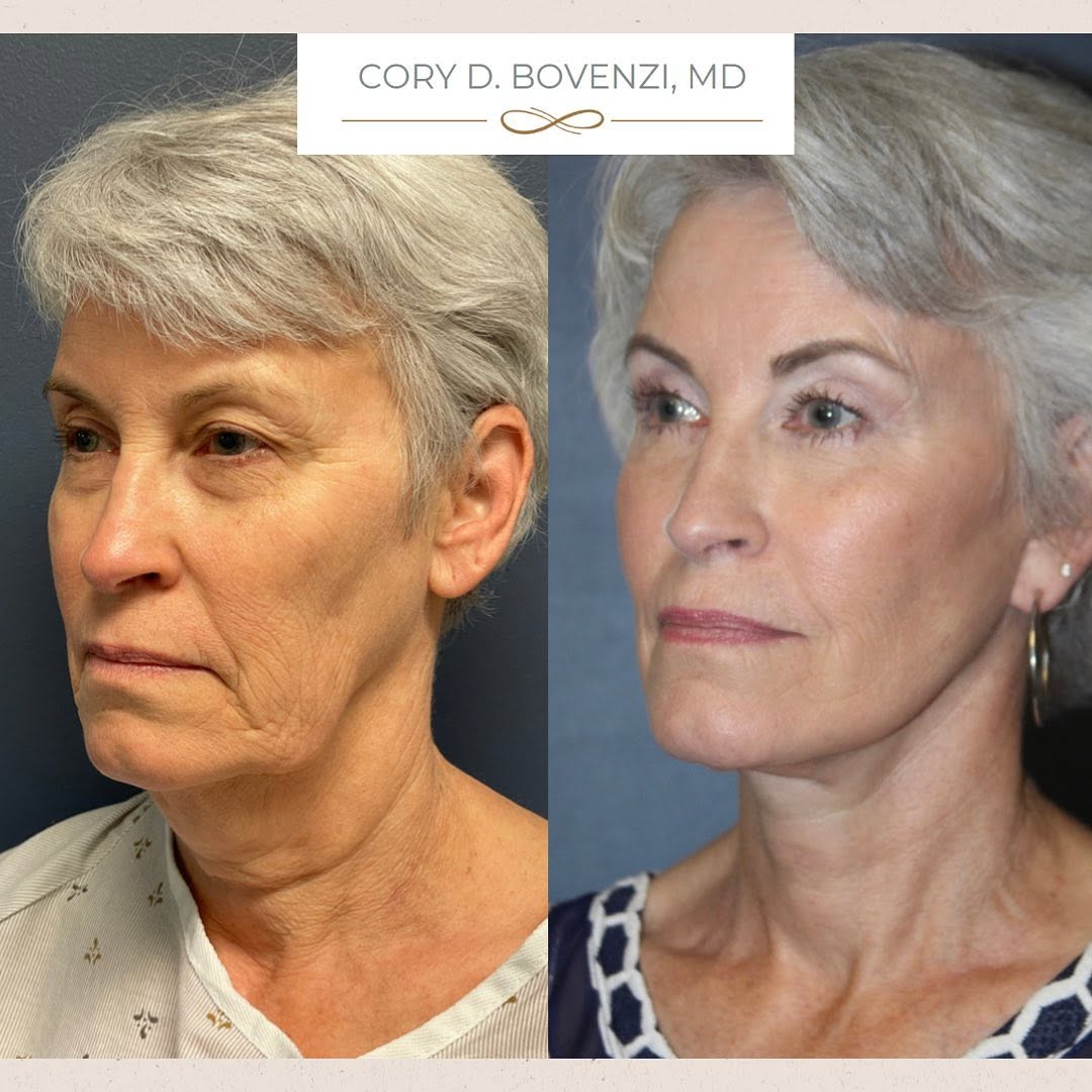 Instagram post by Dr. Cory Bovenzi: Facelift Results! This wonderful patient was feeling like her face didn’t reflect the vitality she felt on the inside. Here, I performed a f…