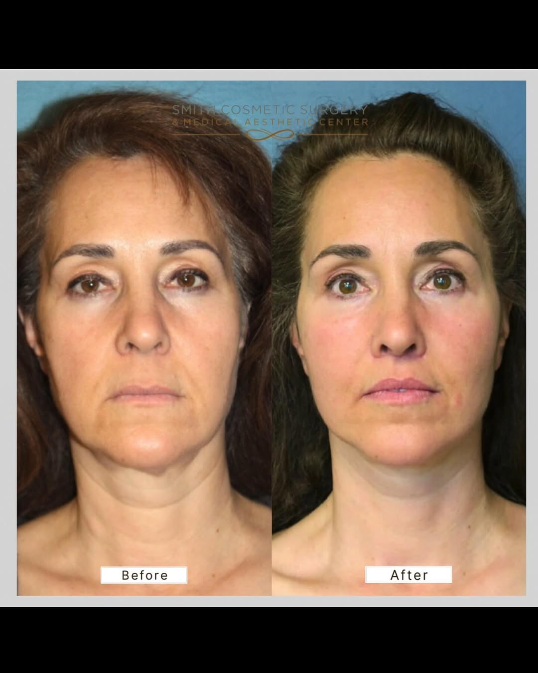 Instagram post by Dr. Cory Bovenzi: Deep Plane Facelift Results ⭐️ This patient in her mid-50s came to use with concerns about jowls, neck sagging, cheek volume loss, and a thi…