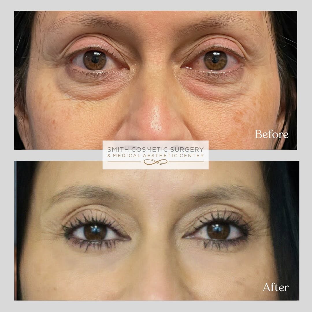 Instagram post by Dr. Cory Bovenzi: 👁️✨ Ready to say goodbye to tired, puffy eyes and hello to a refreshed, rejuvenated YOU? Our stunning 45-year-old patient came to us with c…